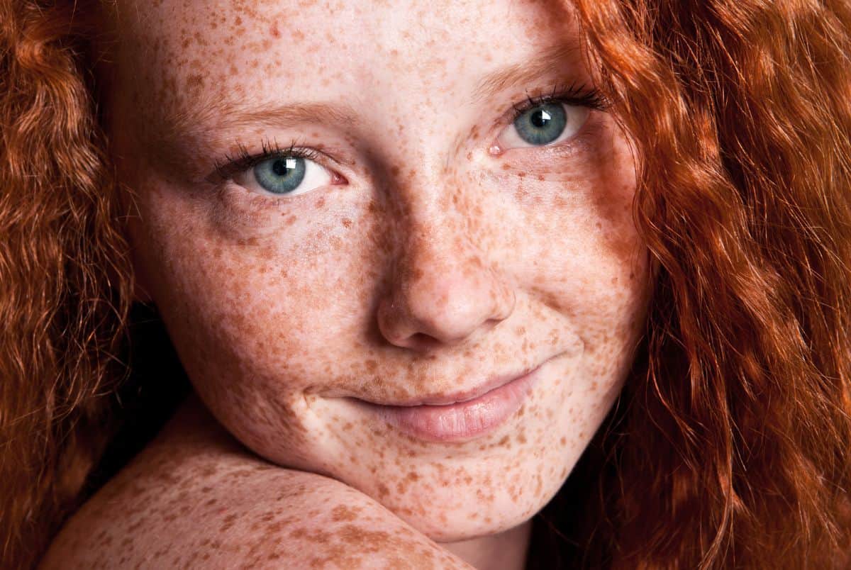 love your freckles day